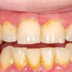 Cara Membersihkan Karang Gigi Dengan Aman Dan Efektif