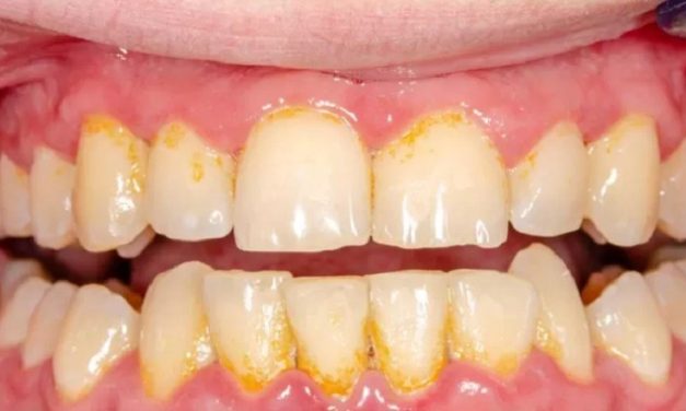 Cara Membersihkan Karang Gigi Dengan Aman Dan Efektif