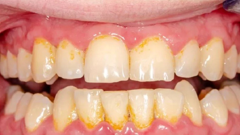 Cara Membersihkan Karang Gigi Dengan Aman Dan Efektif