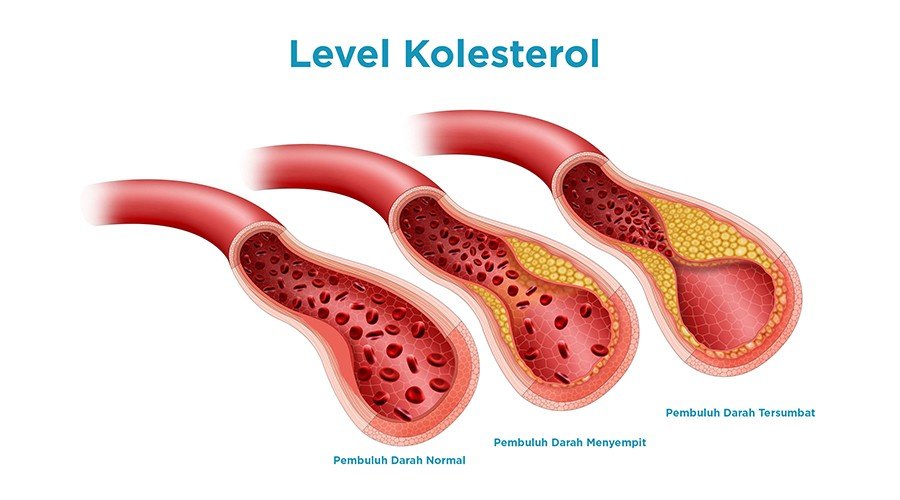 Kolesterol Tinggi Dan Risiko Penyakit Jantung: Wajib Diketahui